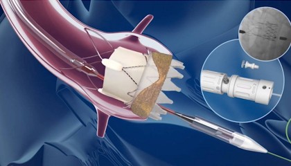 独家｜监管挑战加剧，波士顿科学退出全球心脏瓣膜业务