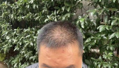 “还能反光!”长沙男子植发近9月称后脑勺“像狗啃过”