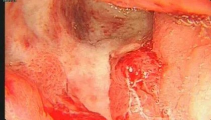 24岁女演员确诊“癌王”，崩溃痛悔：大家别像我这样