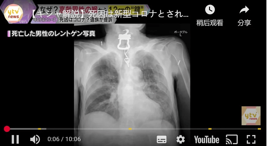 日本82岁老人喉咙痛被确诊新冠病死， X光发现是钥匙卡喉咙
